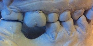extruzie molar superior