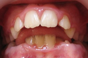 interpunerea limbii intre dinti