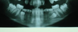 premolari inclusi radiografie