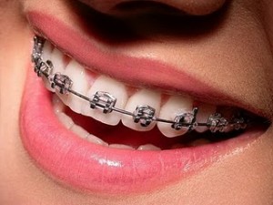 braces1